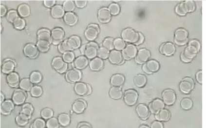 Derek, blood sample fifteen minutes after the beeem device was used: red blood cells round and separated.