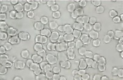 Derek, baseline blood sample: red blood cells clumped together in compact clusters and short chains.