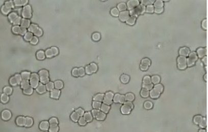 Lani, baseline blood sample: red blood cells clumped together in compact clusters and short chains.