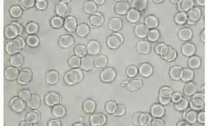 Miquela, blood sample fifteen minutes after the beeem device was used: red blood cells round and separated.