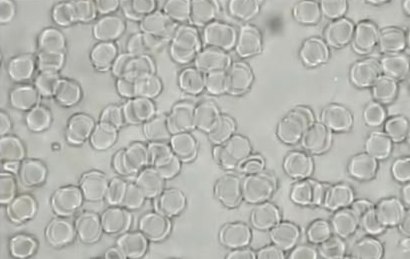 Miquela, baseline blood sample: red blood cells clumped together in compact clusters and short chains.